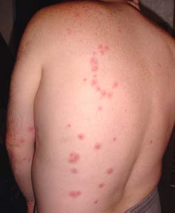 A person with their shirt removed showing the many bites of a bed bug